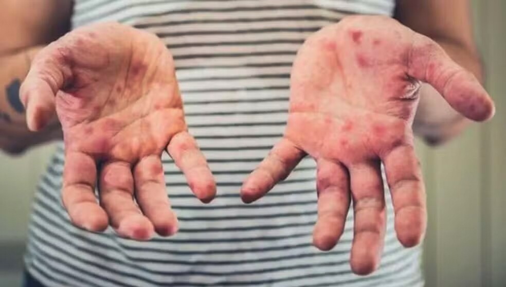 Agevisa investiga caso suspeito de sarampo em Rondônia