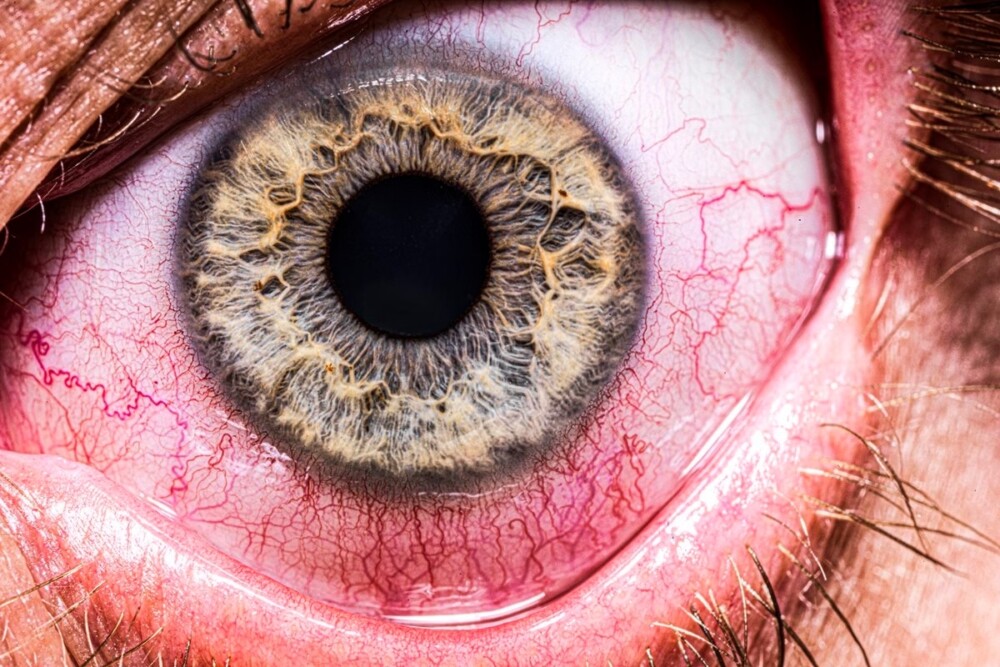 Homem descobre verme vivo dentro do olho após meses de visão embaçada
