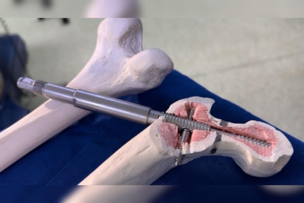 Implante inédito desenvolvido no Brasil melhora tratamento do fêmur