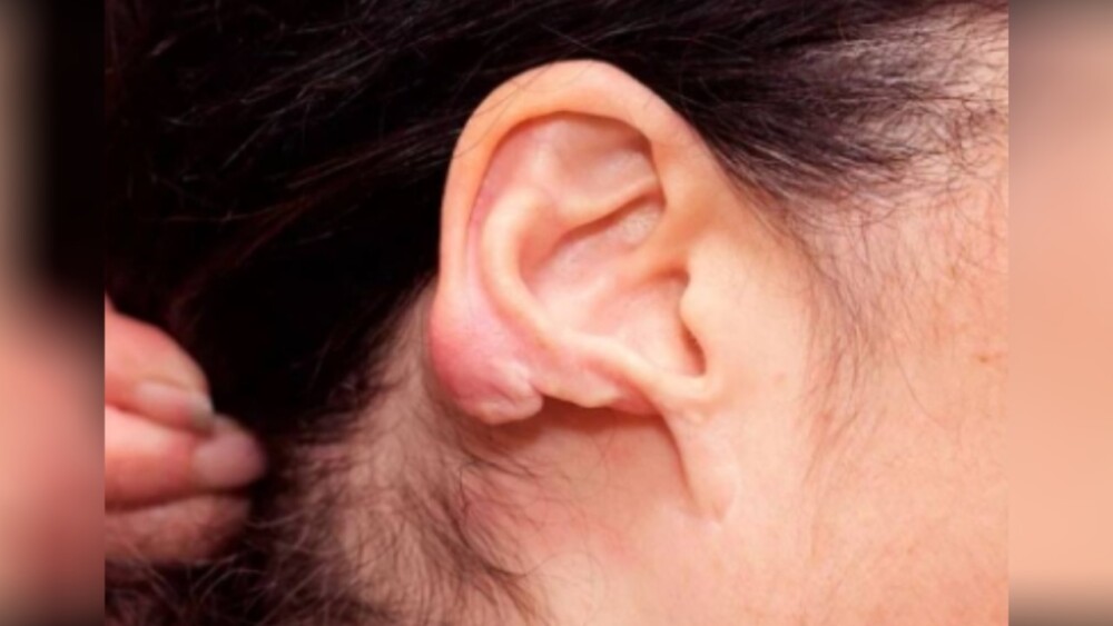 Mulher tem parte da orelha arrancada em briga com namorado em Vilhena, RO