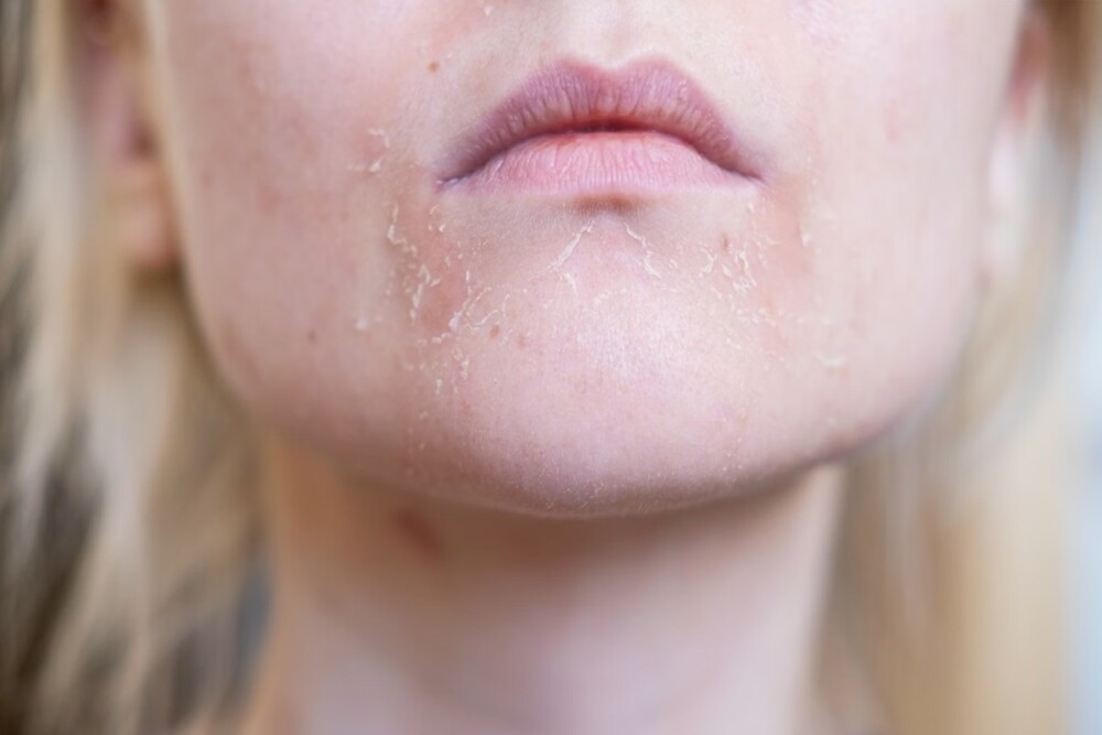 Pele pode revelar os primeiros sinais de diabetes e colesterol alto