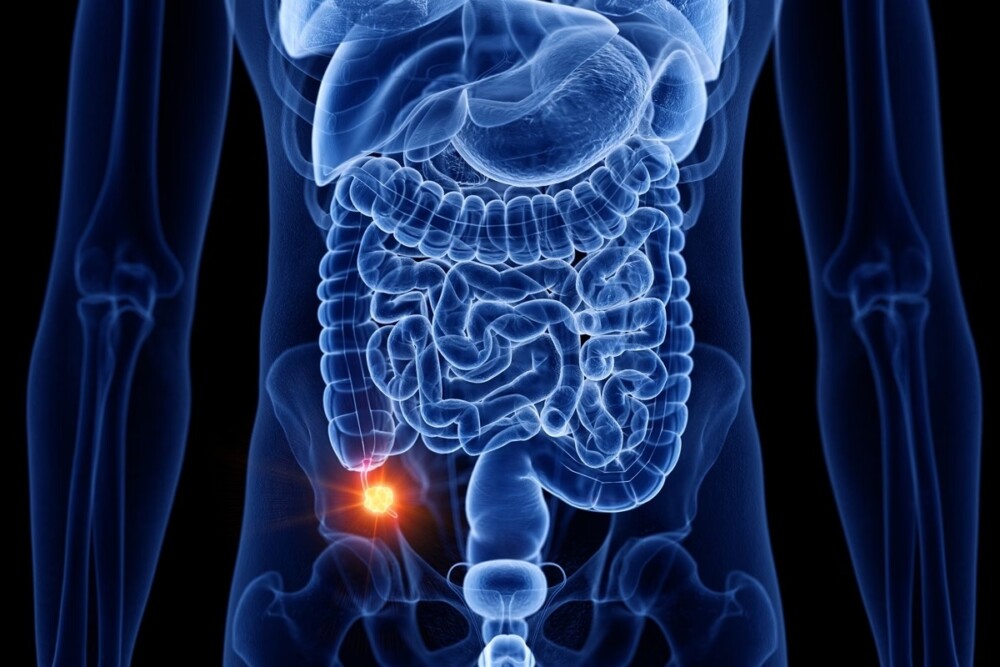 Câncer que antes era raro tem aparecido mais entre jovens. Saiba qual