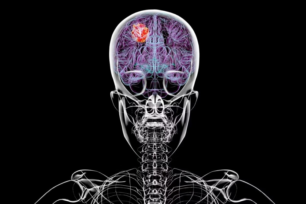 Dieta pode melhorar efeito de tratamento contra tumor cerebral grave