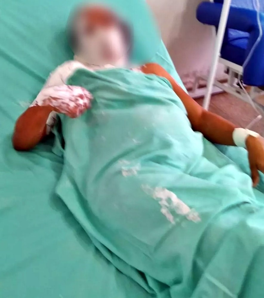 Mulher de 37 anos, que está grávida, tem 30% do corpo queimado pelo próprio filho, em Vale do Anari, RO