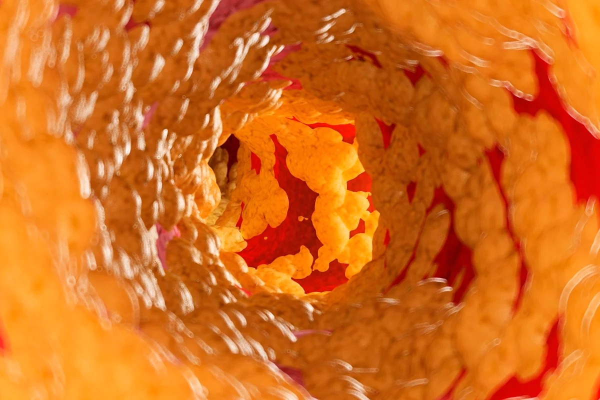 Cardiologista explica o que acontece no corpo quando artérias entopem
