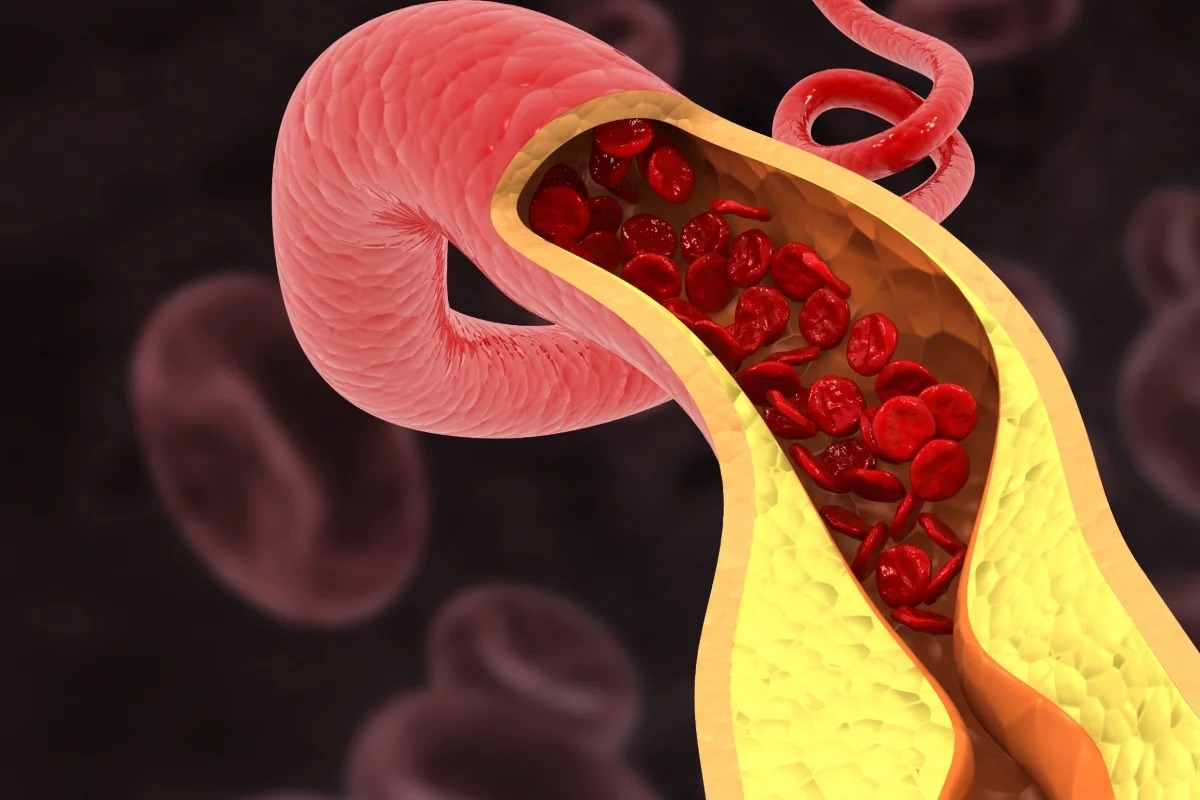Cardiologistas apontam hábitos que ajudam a “limpar” as artérias