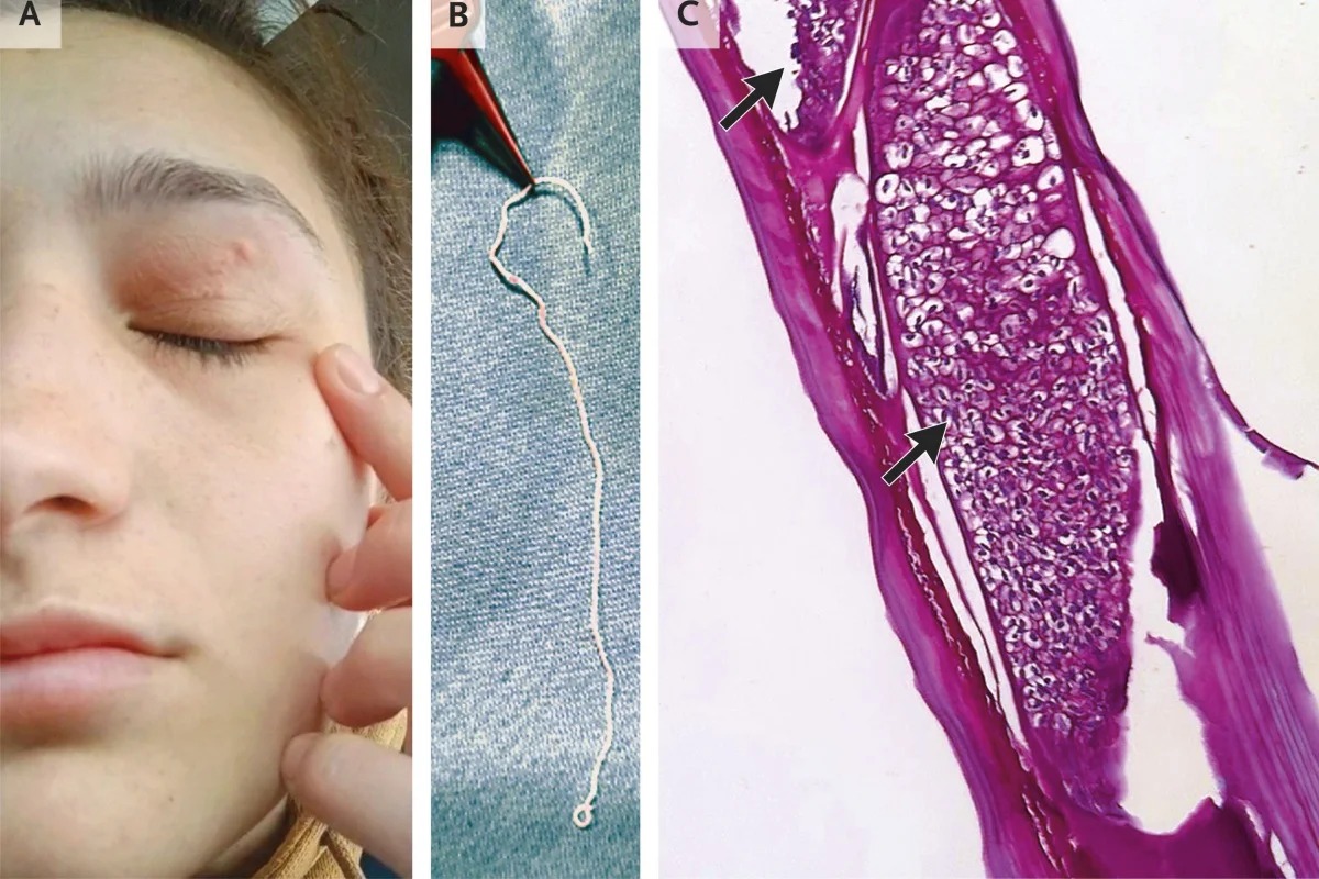 Verme vivo de 11 cm é retirado da pálpebra de mulher na Romênia