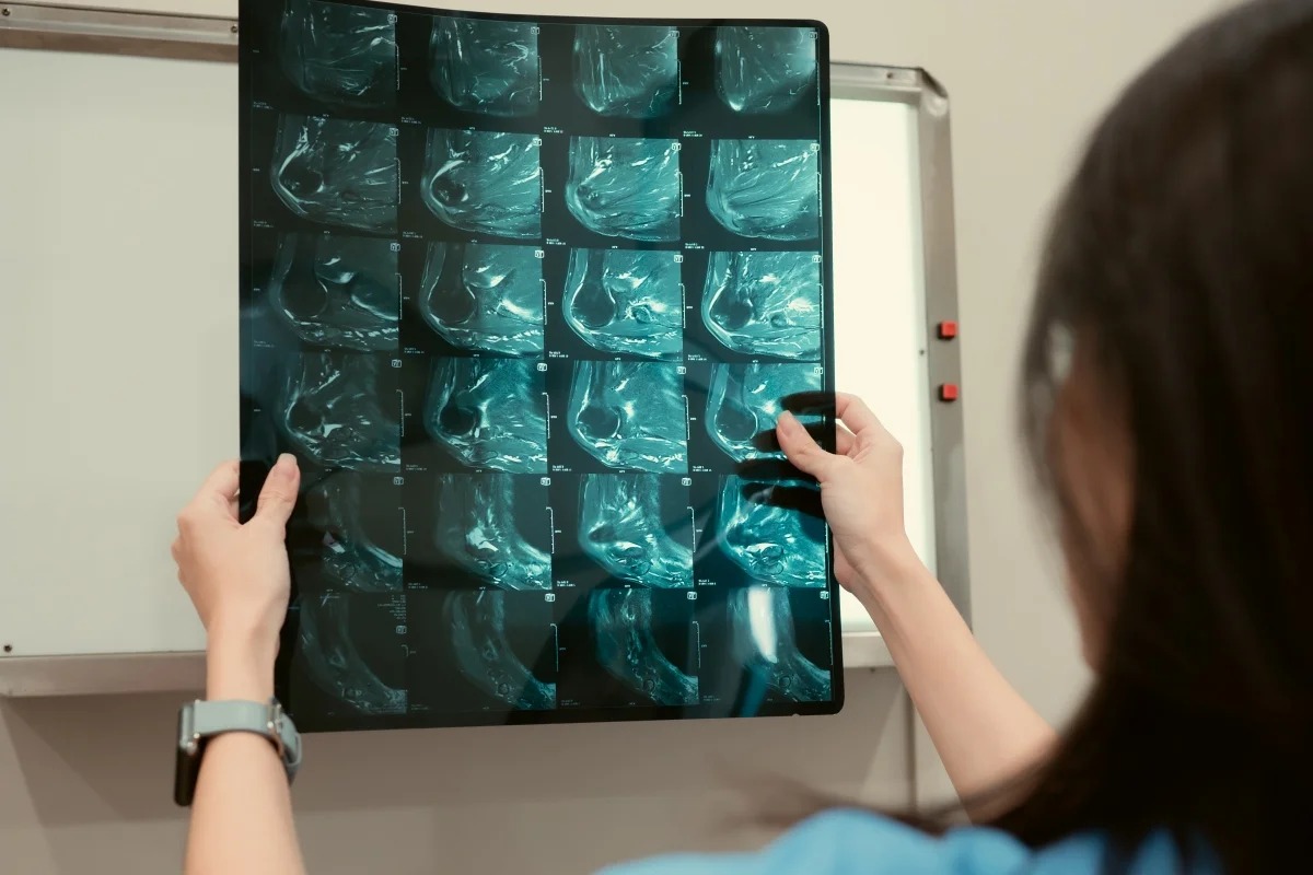 IA consegue prever risco de câncer de mama com 5 anos de antecedência