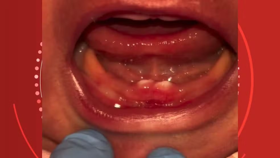 Bebê nasce com condição rara e passa por cirurgia nos primeiros dias de vida