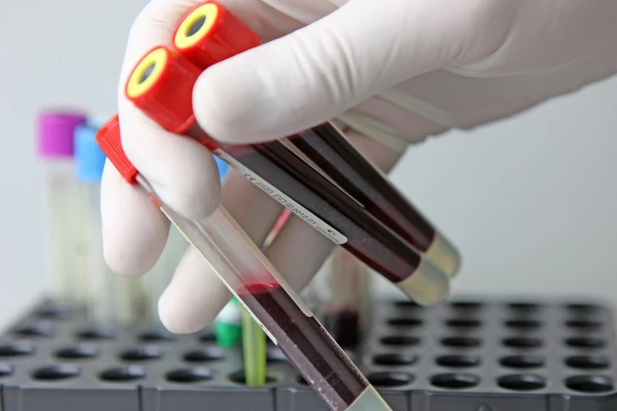 Cresce uso de exames de sangue sem validação para câncer