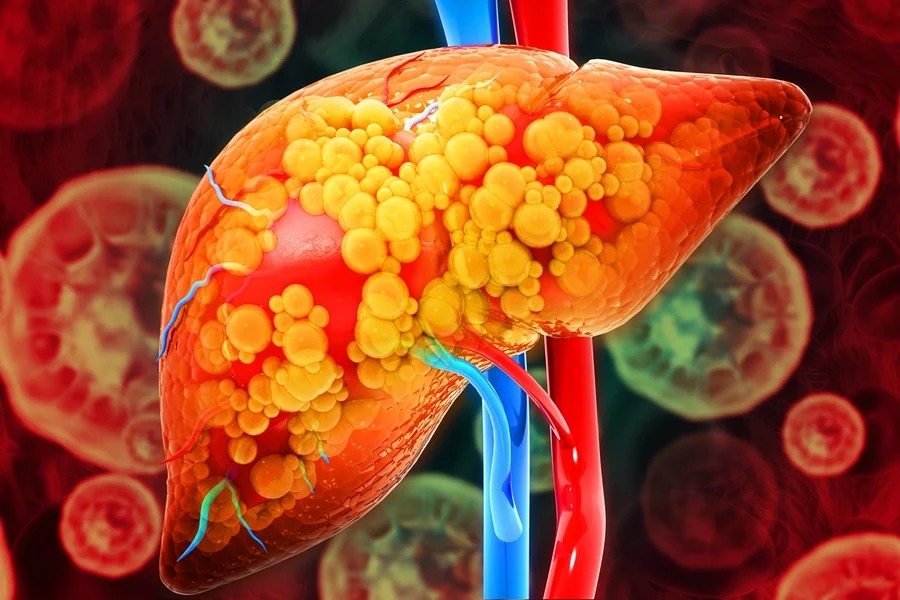 Hepatologista destaca sinais comuns de gordura no fígado