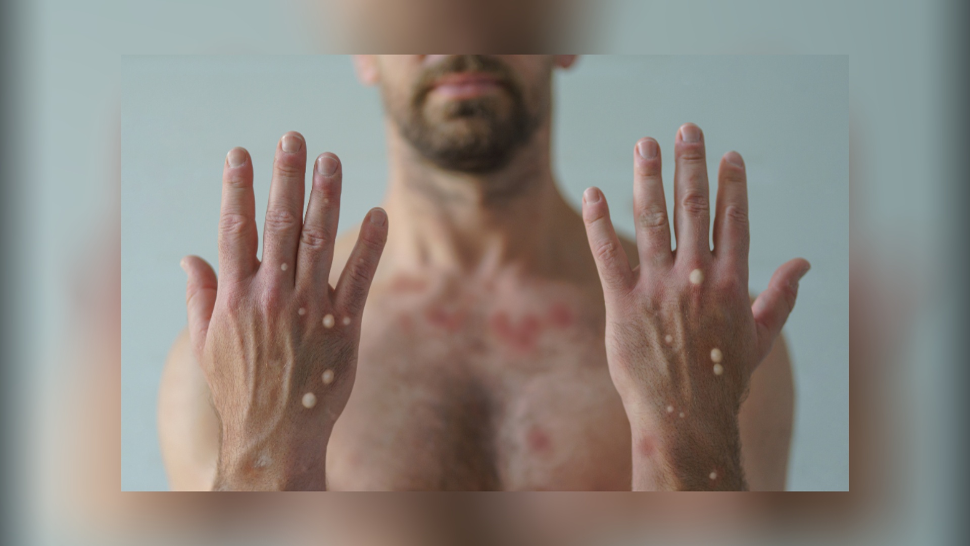 Rondônia já registrou seis casos suspeitos de Mpox