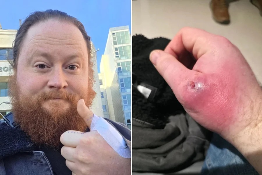 Falsa-viúva pica homem e causa necessidade cirúrgica