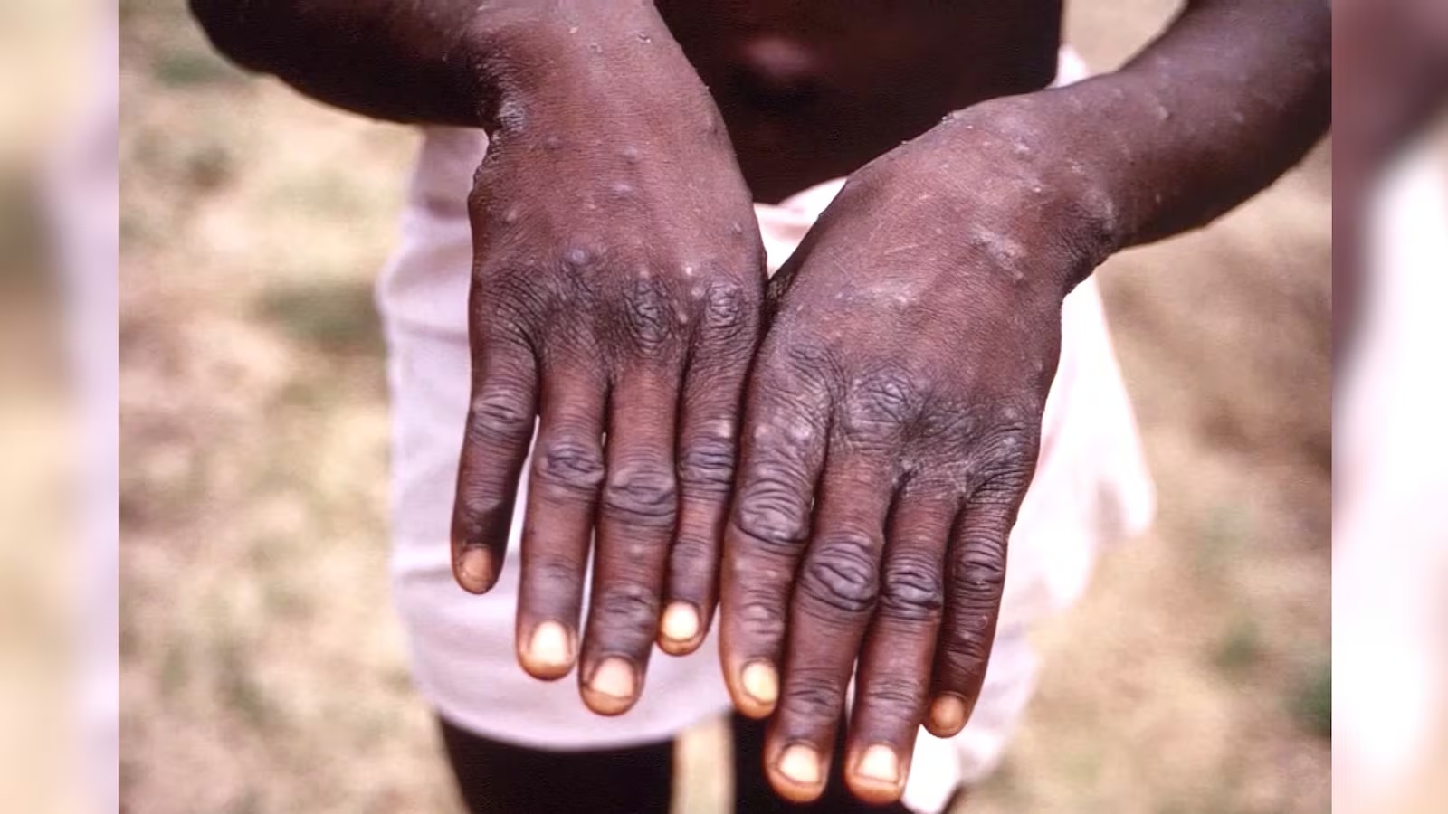 Alta de Mpox no Brasil acende alerta de infectologista