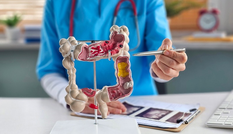 Idade lidera fatores de risco para câncer colorretal