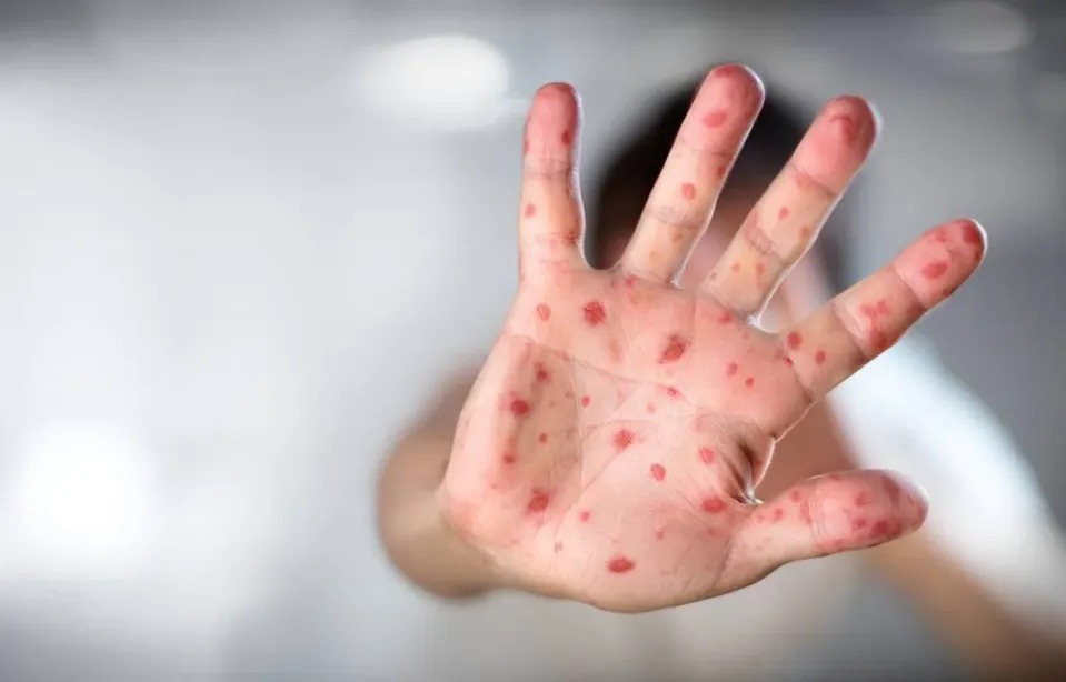 Primeiro caso de Sarampo em 2026 é confirmado no Rio