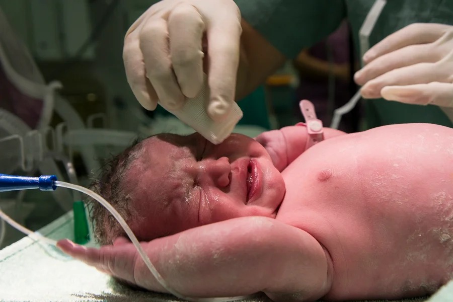 Bebês com herpes congênita ficam mais tempo na UTI, revela estudo