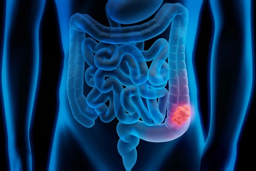 Sinais discretos dificultam diagnóstico precoce do câncer digestivo no país