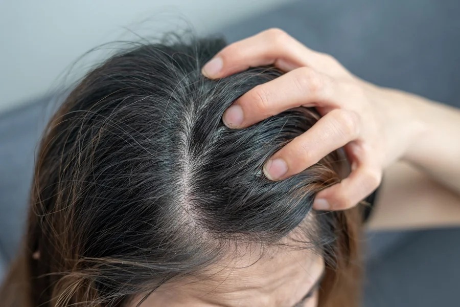 Como tratar a dermatite seborreica e reduzir a caspa no couro cabeludo