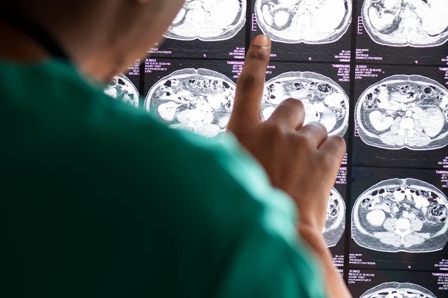 Medicamento antiparasitário é estudado como alternativa no câncer cerebral