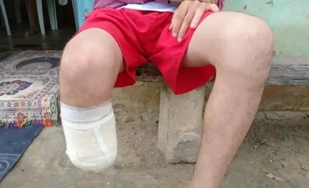 Servidor corta o próprio pé em golpe de indenização milionária