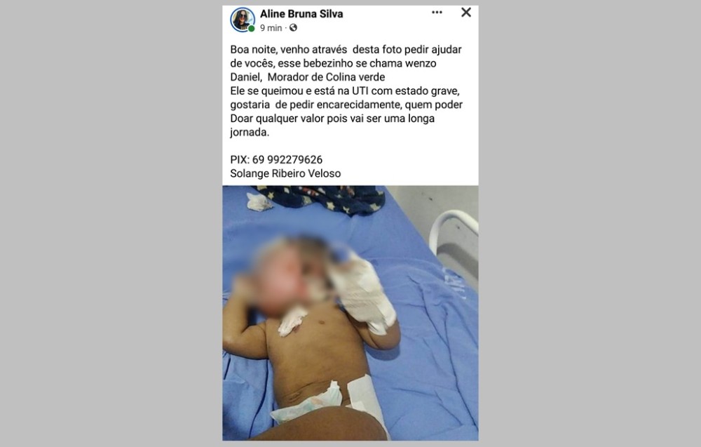 Impactante! Bebê de apenas um ano, sofre queimaduras severas no rosto, cabeça e parte do corpo, em Colina Verde, RO