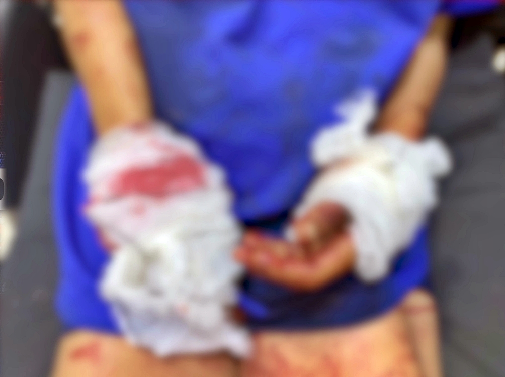 Mulher é baleada nas duas mãos; PM apreende pistola no Orgulho do Madeira, em Porto Velho, RO