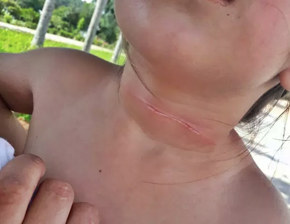 Criança fica com lesão no pescoço provocada por linha de pipa, em Jaru, RO