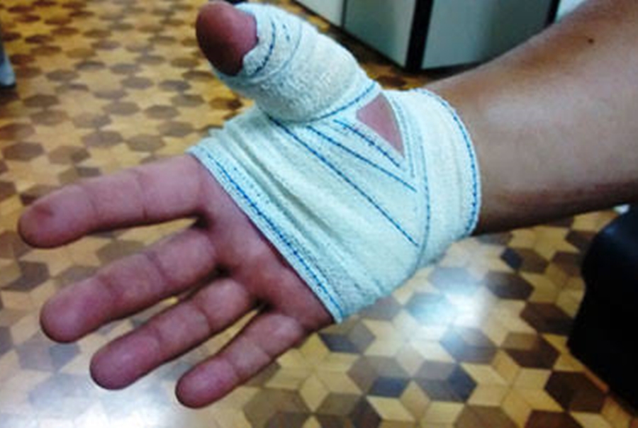 Homem de 55 anos é ferido por disparo de espingarda enquanto caçava em Ariquemes